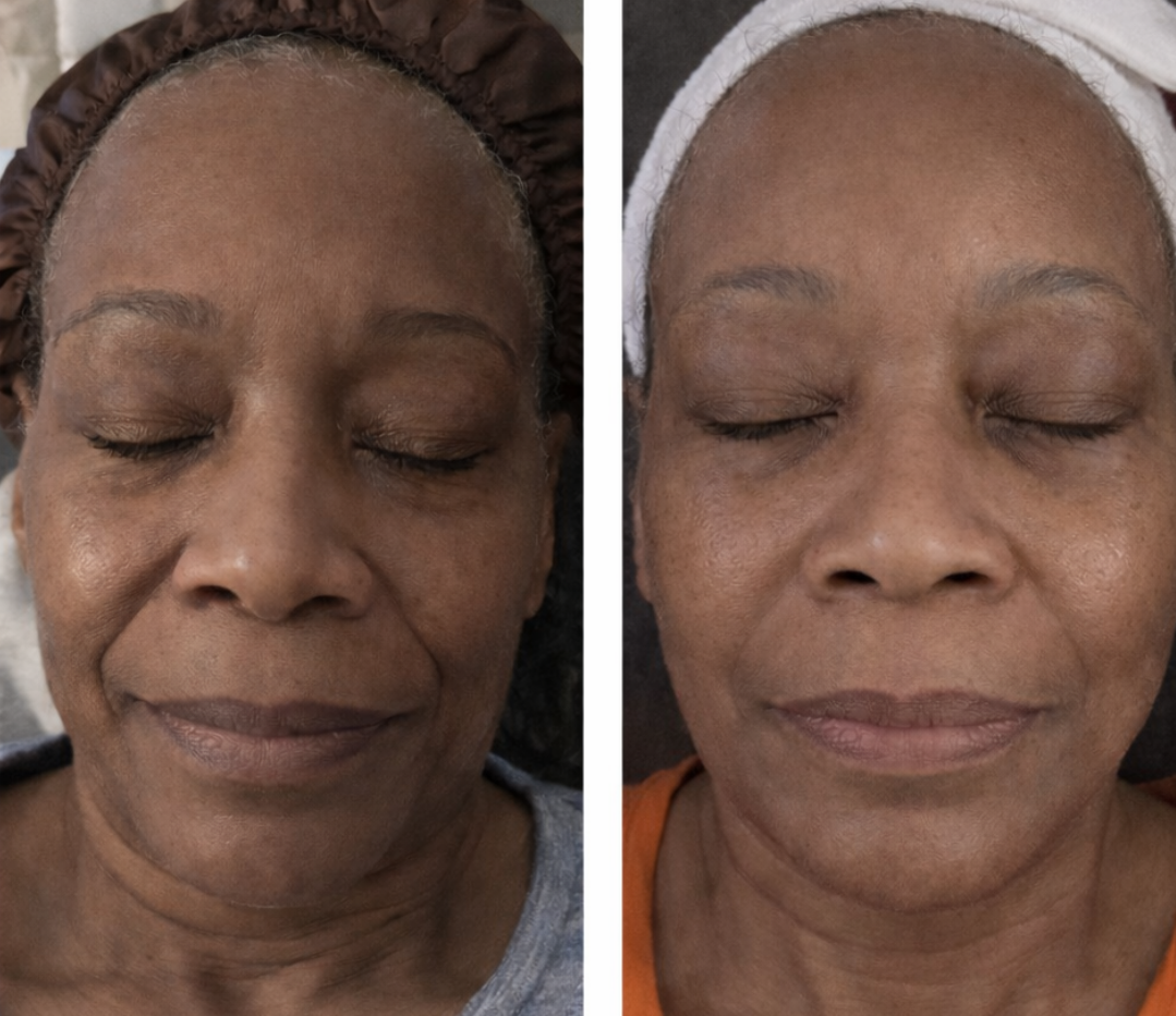 Navaro™ Collagen Peptide Lifting Ampoule
